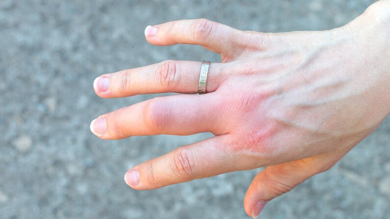 jammed finger
